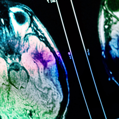 Neurodisease Resources