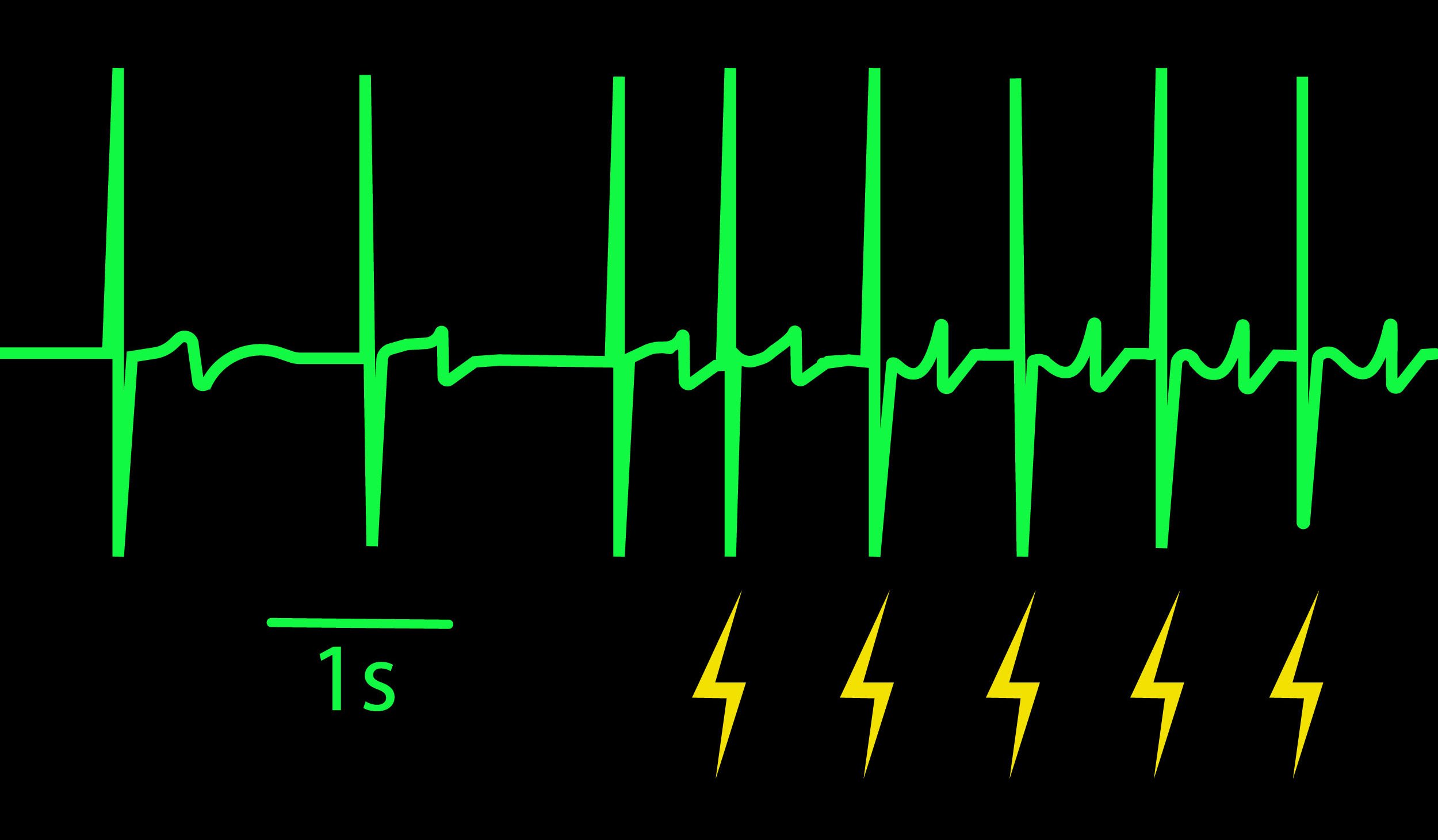 Cardiac Pacing