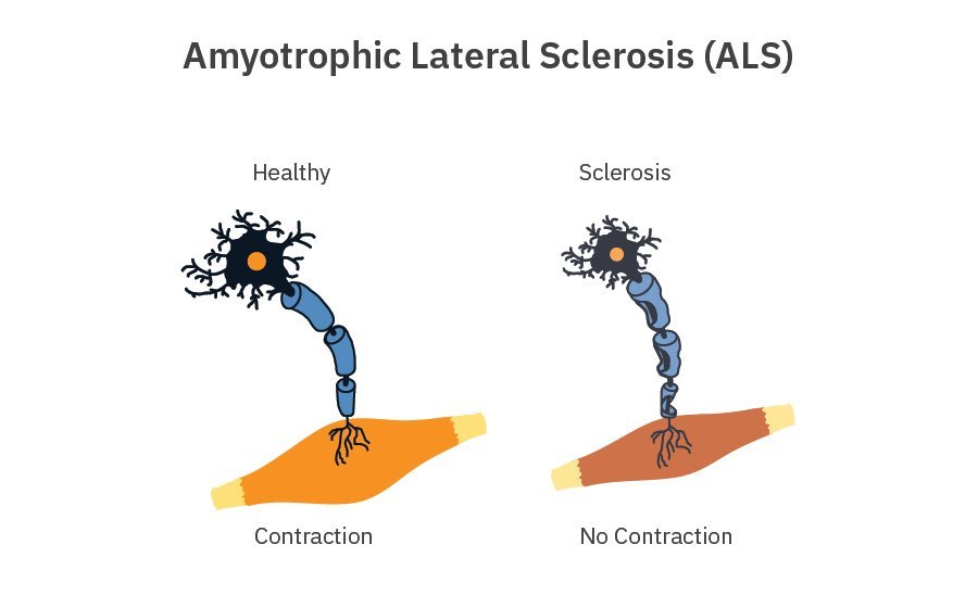 ALS Infographic