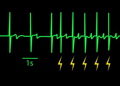 Cardiac Pacing